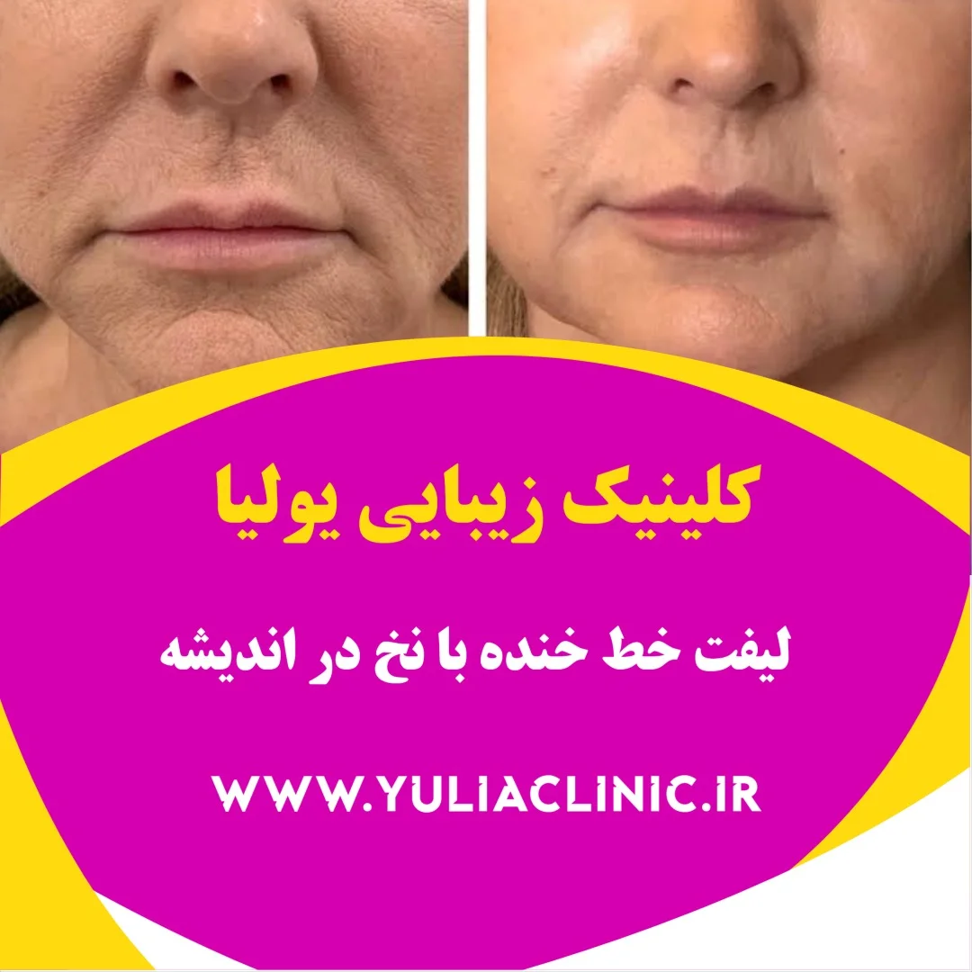 راهنمای روش‌های کاهش خط خنده و کاربرد لیفت با نخ